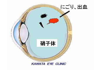 飛蚊症の眼球イメージ