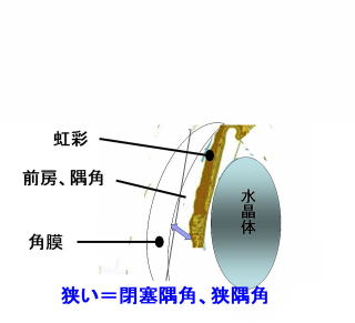 閉塞隅角、狭隅角