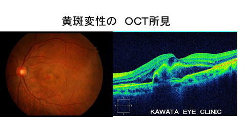 加齢黄斑変性のOCT