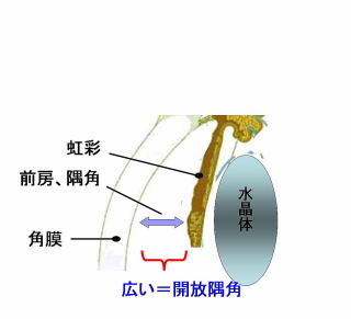 開放隅角