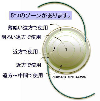 多焦点眼内レンズイメージ