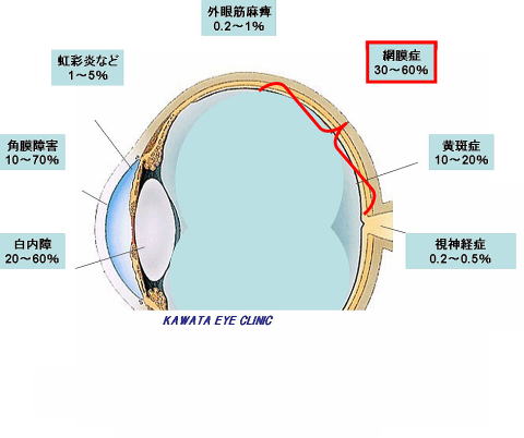 糖尿病の患者さんに起こる眼の合併症