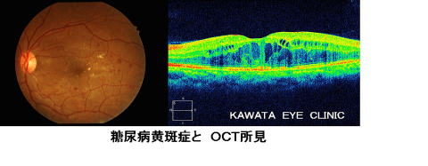 糖尿病黄斑症とOCT所見