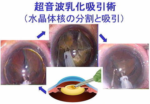 超音波乳化吸引術