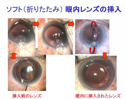 ソフト眼内レンズ