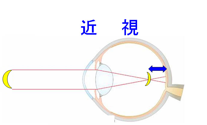 近視