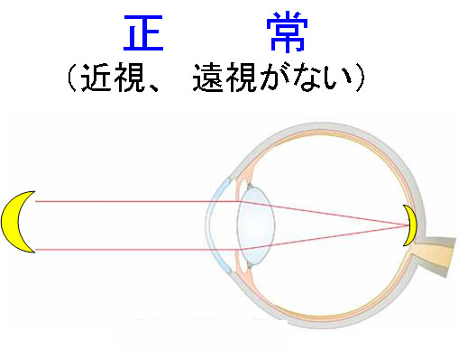 正常（正視）